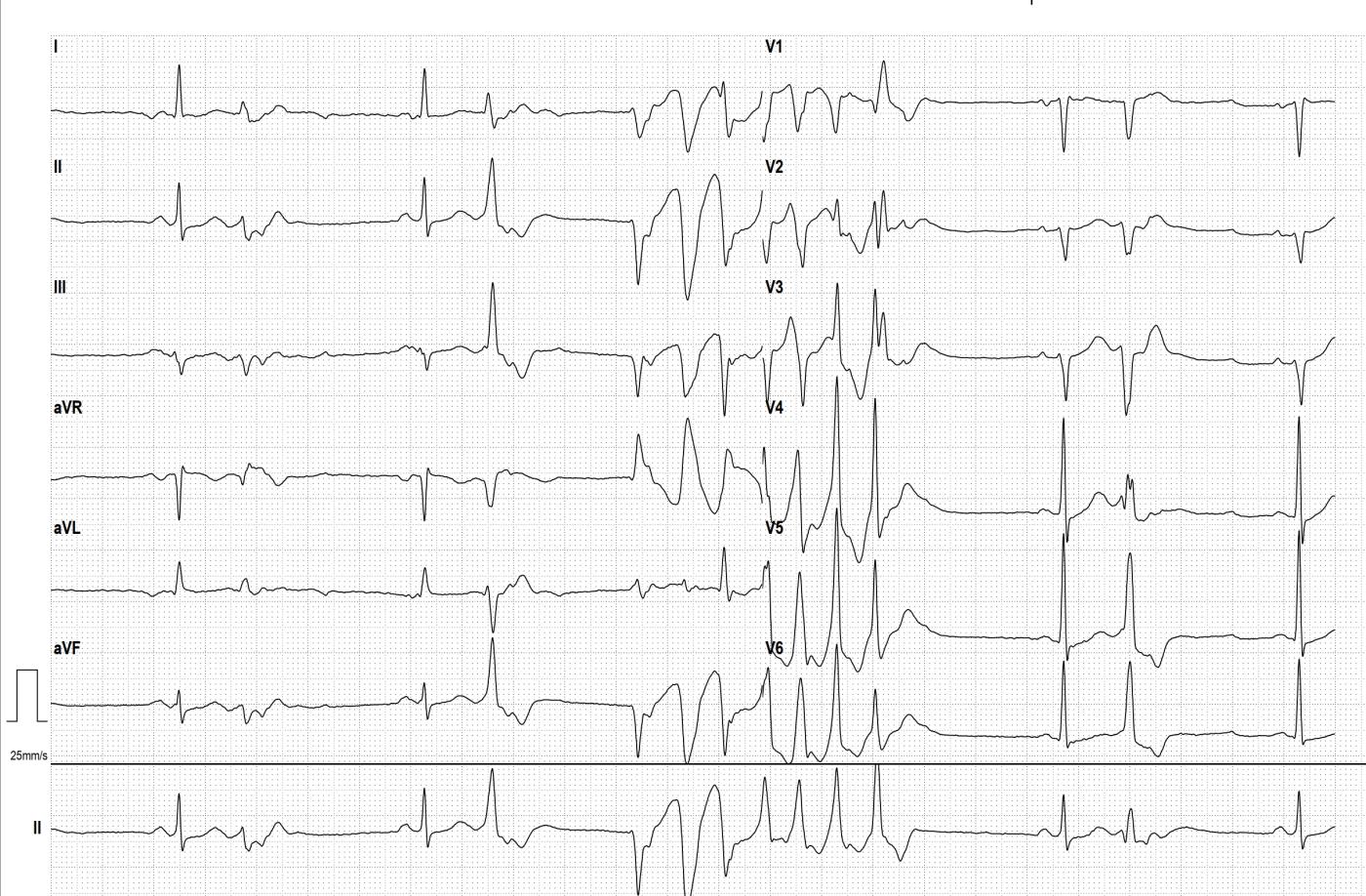 Polymorphic ventricular tachycardia during a stress EKG. What is the
